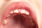 Manchas blancas en los dientes de los niños: causas, prevención y señales de alarma para padres