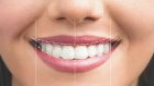 Blanqueamiento dental y Diseño Digital de Sonrisa: lo que debes saber antes de transformar tu sonrisa