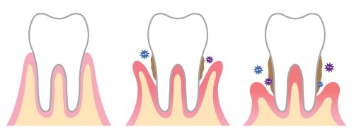 Estudio genético y enfermedad periodontal: la clave para prevenir y personalizar tratamientos en salud bucal