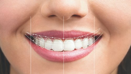 Blanqueamiento dental y Diseño Digital de Sonrisa: lo que debes saber antes de transformar tu sonrisa